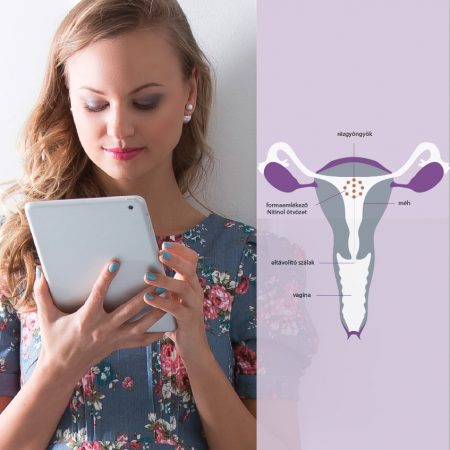 A Rézgyöngy hormonmentes fogamzásgátló elhelyezkedése a méhben A Rézgyöngy hormonmentes fogamzásgátló elhelyezkedése a méhben