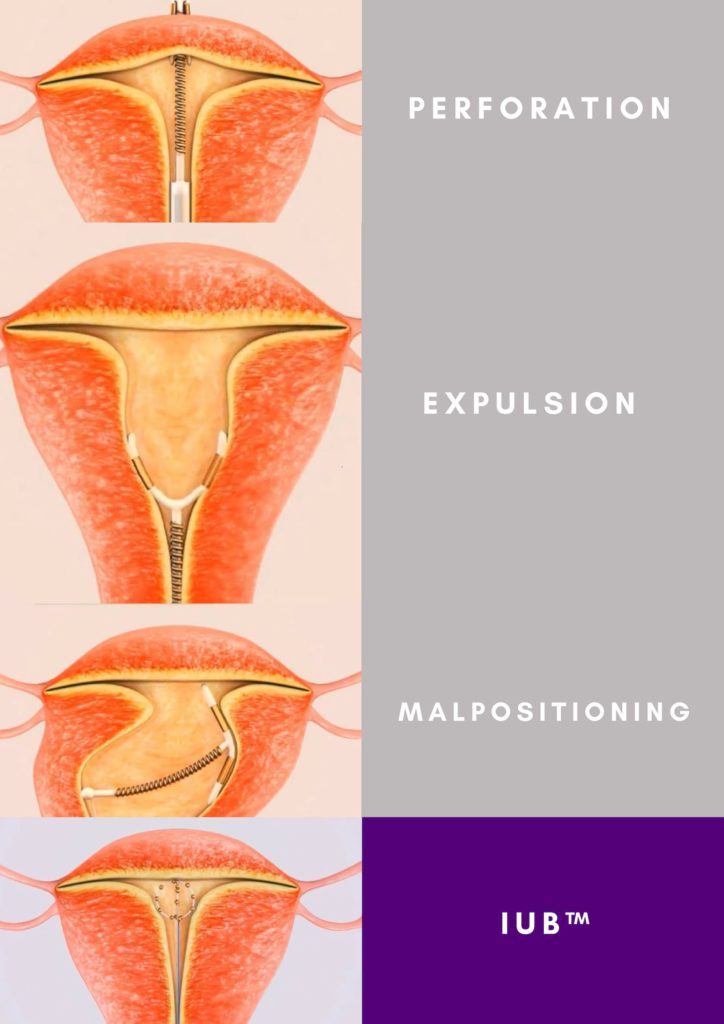 IUD (intrauterin eszköz) Milyen, típusai, előnyei és hátrányai